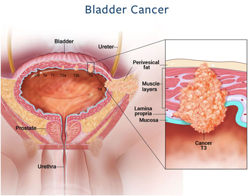 bladder cancer surgeon in Gurgaon