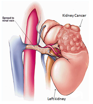 Kidney Cancer Surgeon In Rohtak