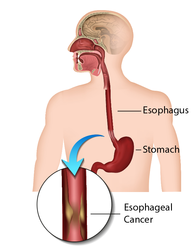 Best Doctors For Esophagus Cancer Treatment In Kanpur