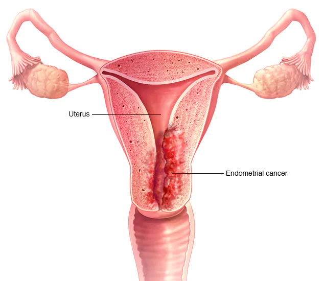 uterine cancer doctor in karnal