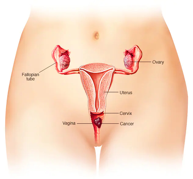 best vaginal cancer treatment doctor in Hisar