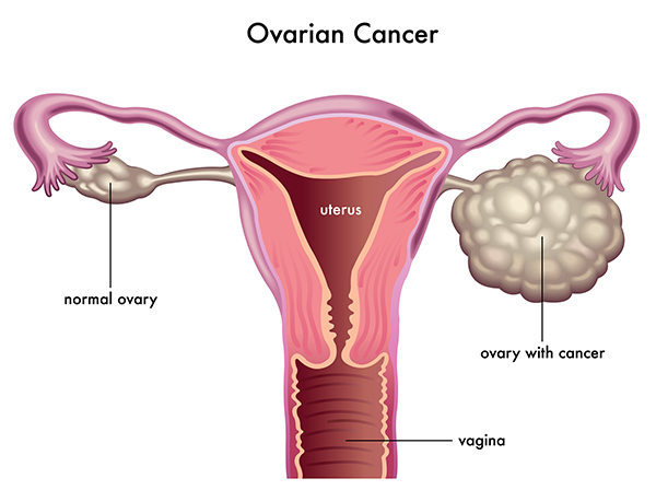 ovarian surgical oncologist in Gurgaon