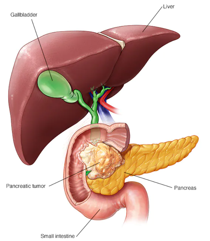 best pancreatic cancer doctor in Rohtak